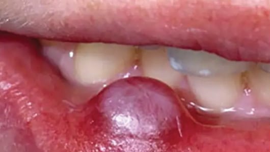 MGM Cancer Institute - throat cancer
