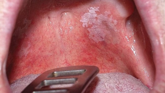 MGM Cancer Institute - oral cancer symptoms