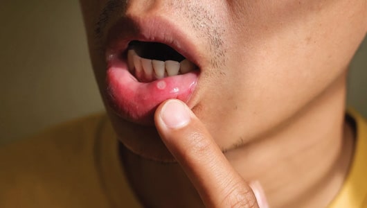 MGM Cancer Institute - symptoms of oral cancer