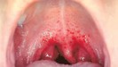MGM Cancer Institute - oral cancer symptoms