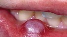 MGM Cancer Institute - throat cancer
