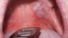 MGM Cancer Institute - oral cancer symptoms