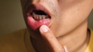 MGM Cancer Institute - symptoms of oral cancer